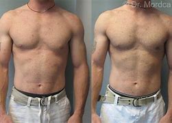 Image result for Gynecomastia Before and After