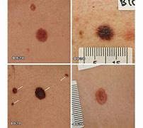 Image result for Early Stages of Melanoma