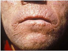 Image result for Facial Skin Blemishes