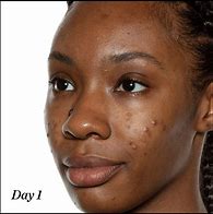 Image result for Blemish On Black Skin