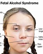 Image result for Deforimities of Pics of Fetal Alcohol Syndrome