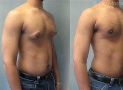 Image result for Teen Gynecomastia