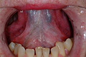 Image result for Stage 4 Mouth Cancer