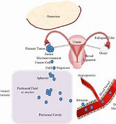 Image result for Metastatic Ovarian Cancer