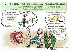 Image result for Erb's Palsy Exercises