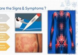 Image result for Rheumatic Fever Symptoms