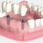 Image result for Dental Implant Fixed Bridge