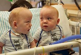 Image result for Conjoined Twins Separated