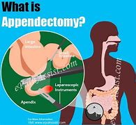 Image result for Appendectomy