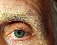 Image result for Common Eye Disorders
