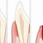 Image result for Periodontal Pocket