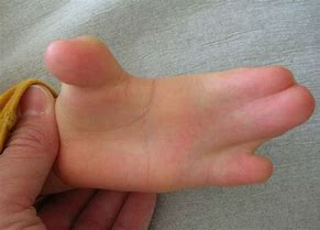 Image result for Cornelia De Lange Syndrome Hands