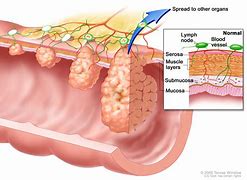 Image result for Stages of Colon Cancer