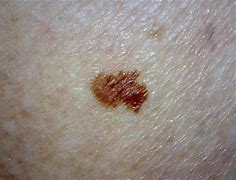 Image result for Late Stages of Melanoma