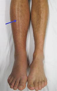 Image result for Dent in Shin