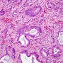 Image result for Small Cell Lung Cancer Illustration