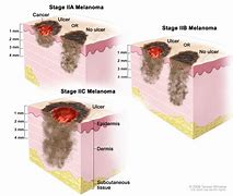 Image result for Stage 4 Melanoma That Has Been Covered