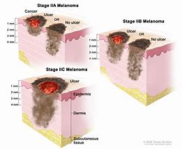 Image result for Stage 4 Melanoma Treatment