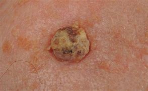 Image result for Squamous Cell Carcinoma