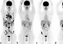 Image result for Pet Scan B-cell Lymphoma Stage 4