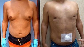 Image result for With Treated Gynecomastia Lyxpo