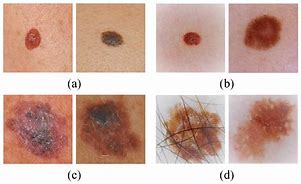 Image result for Stage 4 Melanoma Mole