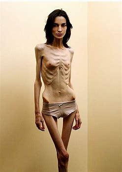 Classy skinny nackt sehr anorexic girl