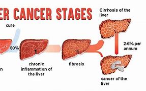 Image result for Primary Liver Cancer Stages