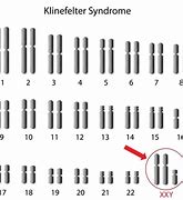 Image result for klinefelter's syndrome