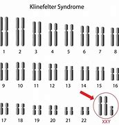 Image result for Klinefelter Syndrome TRT