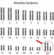 Image result for Kleinfeld Syndrome