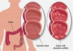 Image result for Stage Four Colon Cancer