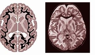 Image result for Canavan Disease Brain
