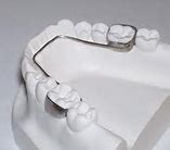 Image result for Space Maintenance and Retention Removable Orthodontic Appliances