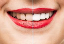 Image result for Smile Teeth Whitening