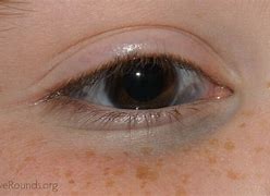 Image result for Black Spot in Eye