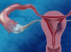Image result for Stage 4 Endometrial Cancer