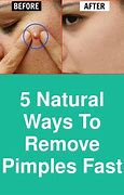 Image result for How to Remove Pimples Fast