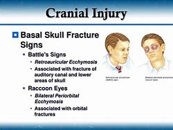 Image result for Basilar Fracture Battle Sign