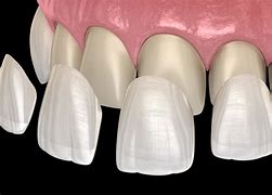 Image result for Veneers for Teeth