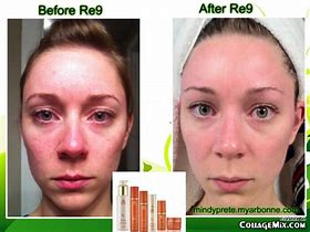 Image result for Arbonne Before and After Acne