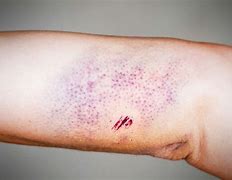 Image result for Red Blemish On Skin