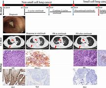 Image result for First Sign Lung Cancer