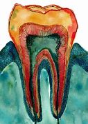 Image result for Teeth Stain Ezample