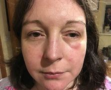 Image result for Woke Up with Swollen Under Eye