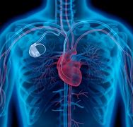Image result for Heart Pacer