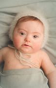 Image result for Down Syndrome Infant