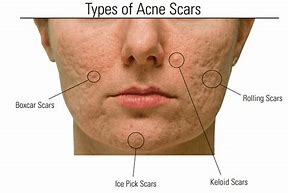 Image result for Scars On Brown Skin