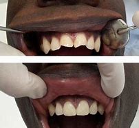 Image result for Dent Incisive