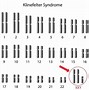 Image result for Male with Klinefelter Syndromekaryotype S